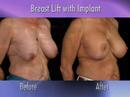 Dr. Nachbar on Breast Lift with Breast Augmentation