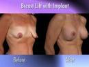Dr. Nachbar on Breast Lift