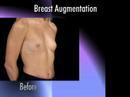 Dr. Nachbar on Breast Augmentation