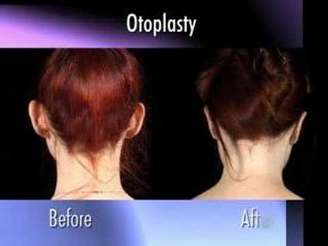 Dr. Nachbar on Otoplasty (ear pinning)
