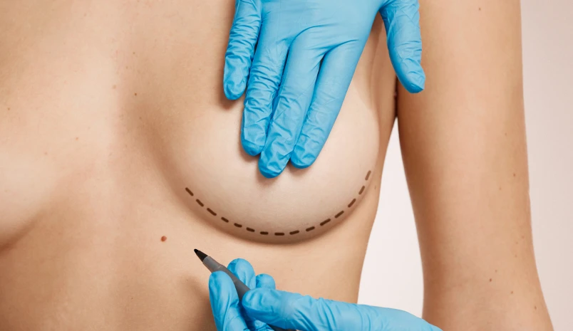 Breast Reduction