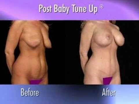 Dr. Nachbar on Mommy Makeover Procedures