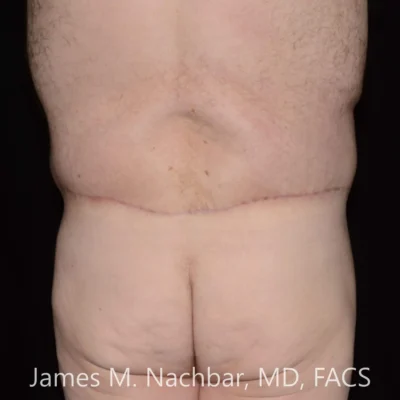 6 Months After