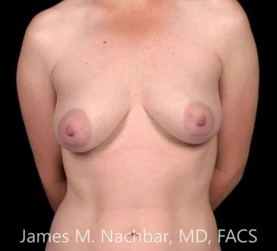 Before Both Procedures