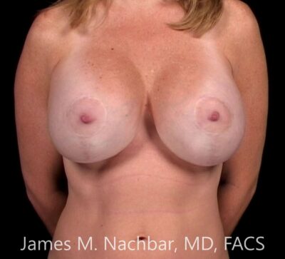 After Both Procedures