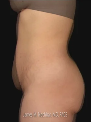 6 Months After