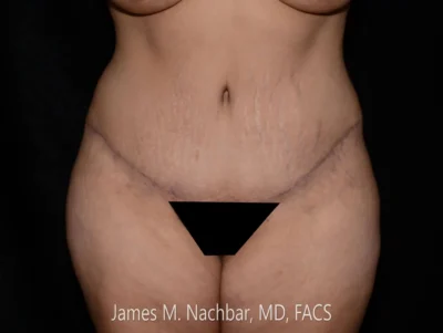 6 Months After
