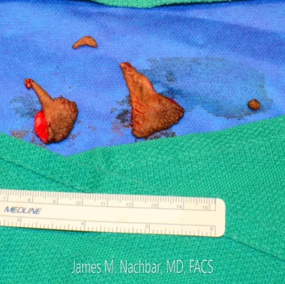 Surgical Tissue