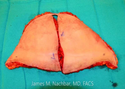 Tissue Removed