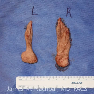 Tissue Removed