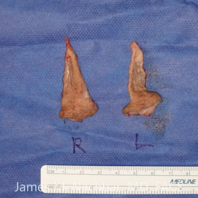 Tissue Removed