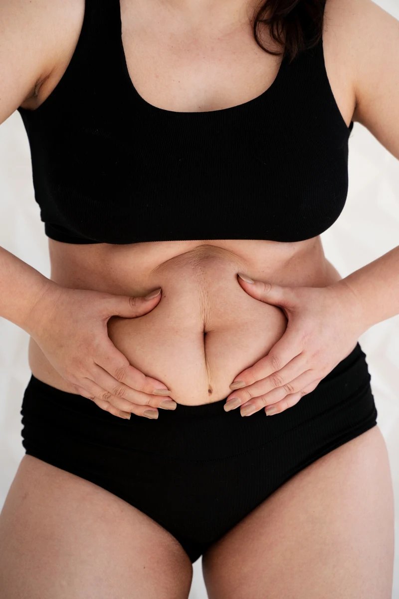 No Drain Tummy Tuck